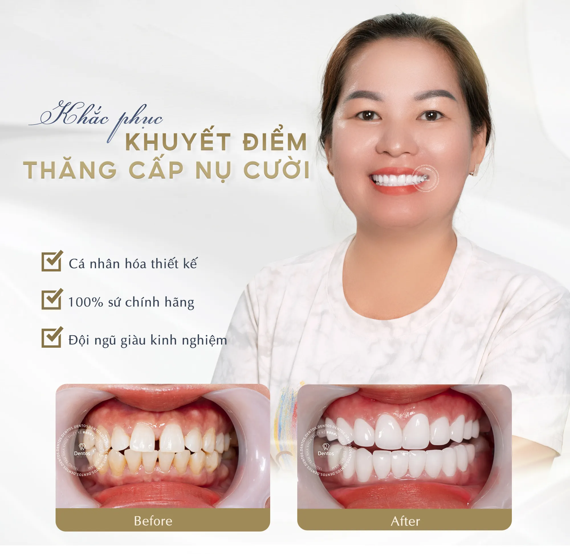 Bọc răng sứ giúp khắc phục khuyết điểm lớn trên răng